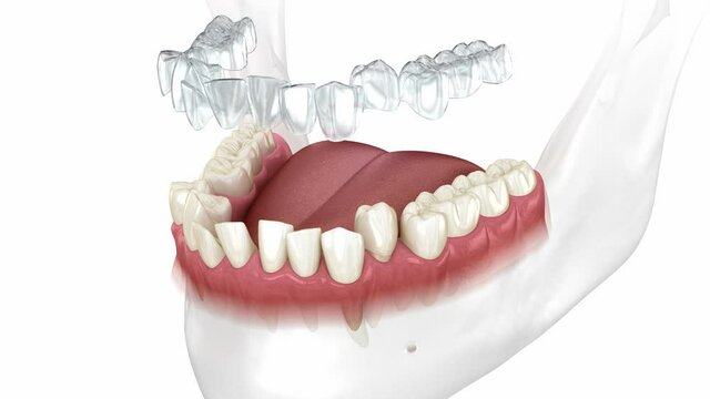 Invisalign braces or invisible retainer make bite correction. Medically accurate 3D animation