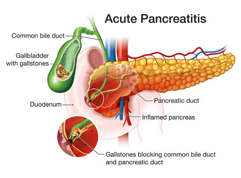 Acute pancreatitis, medically illustration