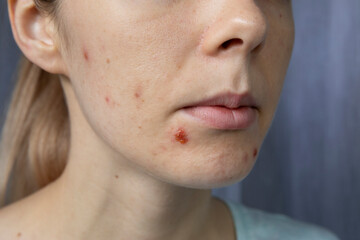 Girl with pimples on her face.