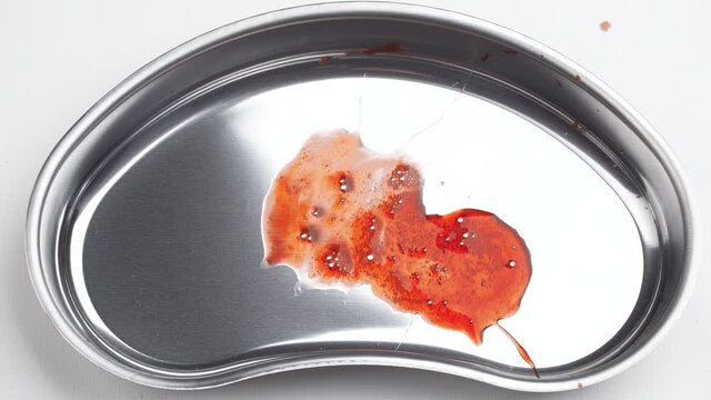 Footage of a bloodied wisdom tooth in a kidney tray