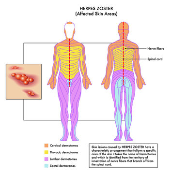 Medical diagram of affected skin areas of Herpes Zoster with annotations