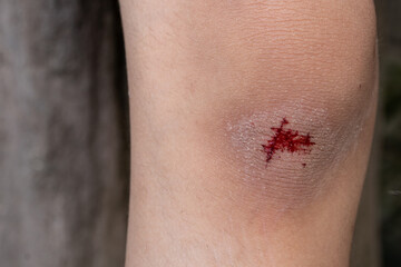 The knee is scratched. Close up on an bleeding scraped child his knee after run accident.
