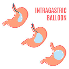 Gastric balloon non surgical weight loss procedure in stomach.  Intragasric balloon placement infographic poster. Health care and medical concept.  Vector illustration in flat style.