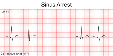 Electrocardiogram show Sinus arrest pattern. Cardiac fibrillation. Heart beat. CPR. ECG. EKG. Vital sign. Life support. Defib. Emergency. Medical healthcare symbol.