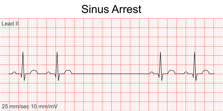 Electrocardiogram Show Sinus Arrest Pattern. Cardiac Fibrillation. Heart Beat. CPR. ECG. EKG. Vital Sign. Life Support. Defib. Emergency. Medical Healthcare Symbol.