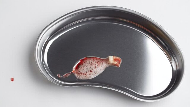 Video of a bloodied wisdom tooth in a kidney tray