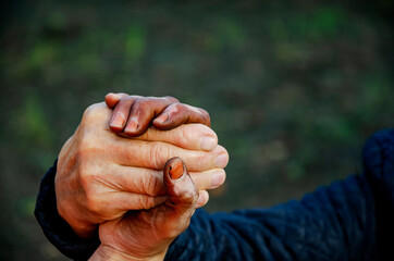 The social problem of relationships between people with disabilities. The concept of kindness and cohesion. Friendship regardless of skin color and nationality. Pigmented spots on the girl's hand