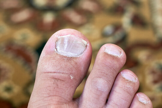 Toenail Fungus or Fungal Nail Infection. Unhealthy condition of leg fingers