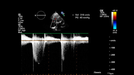 Image of the heart during transesophageal ultrasound with Doppler mode.