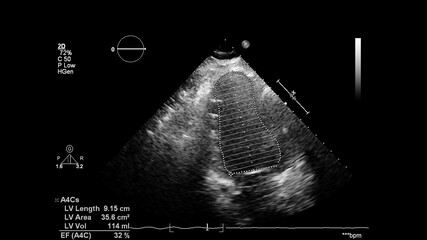 Image of the heart in gray-scale mode during transesophageal ultrasound.