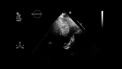 Image of the heart in gray-scale mode during transesophageal ultrasound.