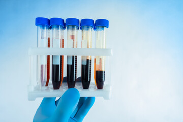 Blood tests. Research of biological fluids. A rubber-gloved hand holds a rack of test tubes. Lab...