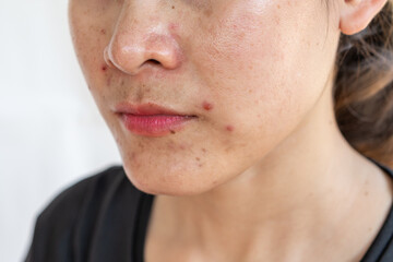 Cropped shot of woman having problems of acne inflamed on her face. Inflamed acne consists of swelling, redness, and pores that are deeply clogged with bacteria, oil, and dead skin cells.