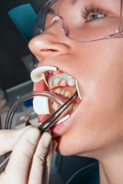 Dental hygiene and beauty procedures in the dental office, close up of teeth whitening treatment on a beautiful woman with blue eyes