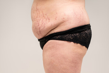 Fat flabby female belly with stretch marks on gray background
