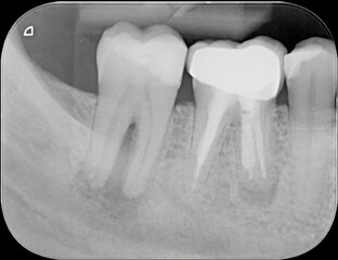 X-ray of two human tooth molars, both showing infections. One has an abscess and one has been root canal treated already and has a crown. - 386161303
