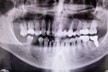 Digital x-ray of teeth profile with root canal, fillings and orthodontic implant