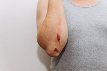Large abrasions on the forearm of a man after a fall.