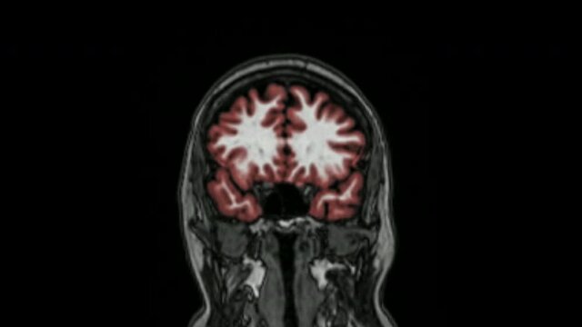 Magnetic resonance imaging of the brain in coronal plane color coded sequence used for diagnosis of memory impairment and Alzheimer disease. MRI brain. Alzheimer disease.