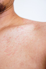 red inflamed skin on a man's body. skin fungus causing white blotches. Atopic eczema
