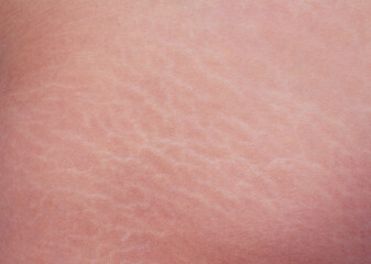 Close up human Skin natural Texture background. Stretch mark Asian woman buttock 