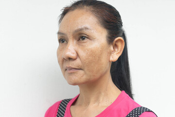 Woman problem skin face blemish on white background