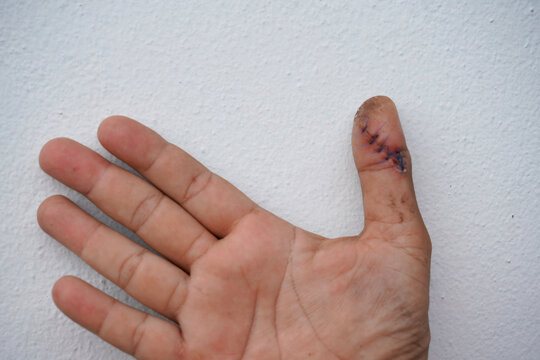 Man's hand and the wound on the finger