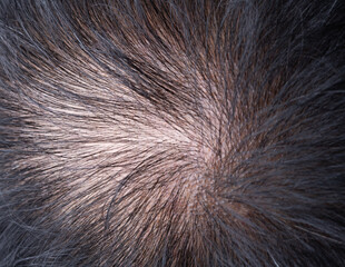 Head of glabrous baldness, Hair skin condition close up on monitor