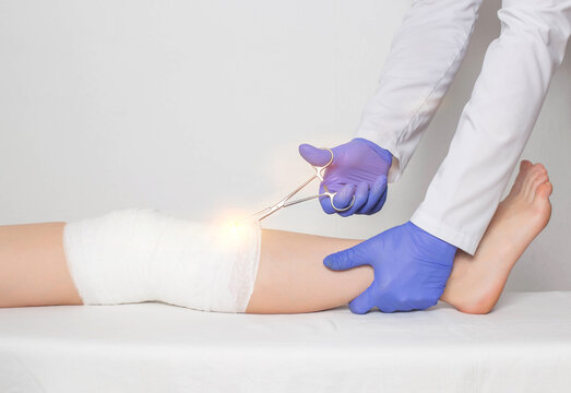 The doctor surgeon removes the plaster cast on the knee of the patient using medical scissors. Concept fracture of the patella and rupture of the quadriceps, copy space