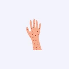 Allergy on hands. Skin covered destruction red rash and scaling serious problems with psoriasis.