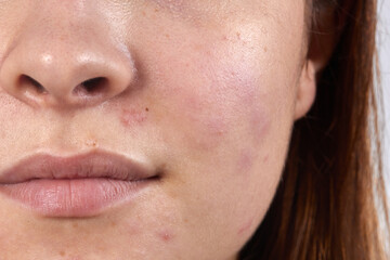 face close-up of redness and pimples skin cleansing