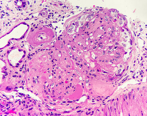 Glomerulus reveals nodular sclerosis and hyaline arteriolosclerosis, magnification 400x, photo...