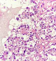 Clear cell carcinoma of the ovary, papillary pattern, magnification 400x, photo under microscope