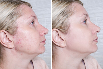 Young woman before and after anti acne treatment, skincare and dermatology concept