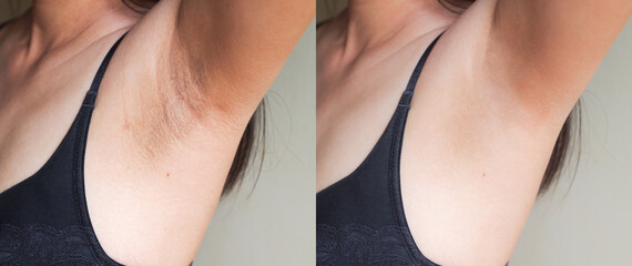 Image before and after skincare cosmetology armpits epilation treatment concept.Problem underarm chicken skin,Fox Fordyce,black armpit in woman. - obrazy, fototapety, plakaty