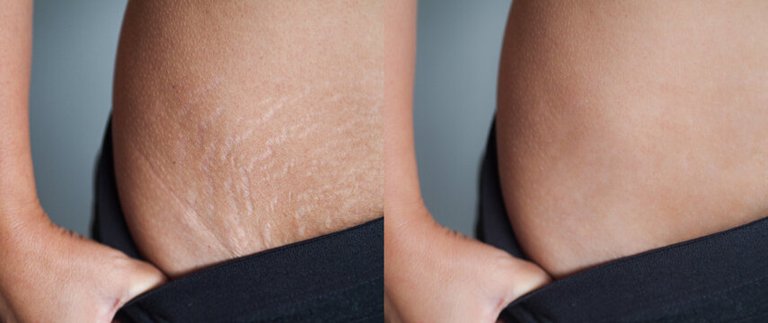 Image before and afer skin stretch marks removal treatment.