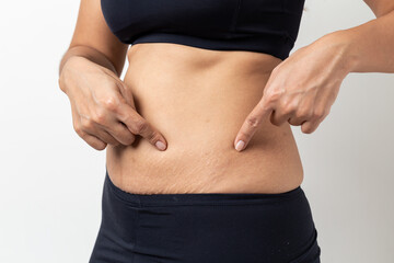 Stretch Marks, Women Show off the belly after birth on white background