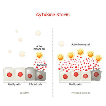cytokine storm or hypercytokinemia. COVID-19 complications