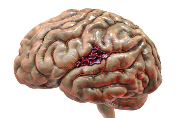 Hemorrhagic stroke, illustration
