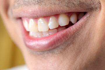 a man smiling showing his teeth