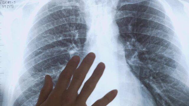 X-Ray of Ribs Picture being Examined by Doctor's Hand - Closeup Detailed Shot