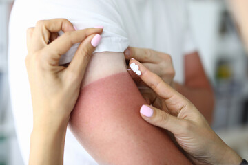 Women's hands apply cream from burns to skin lesions. Sunburn treatment concept