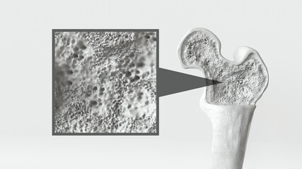 Osteoporosis stage 1 of 3 -- 3d rendering - obrazy, fototapety, plakaty