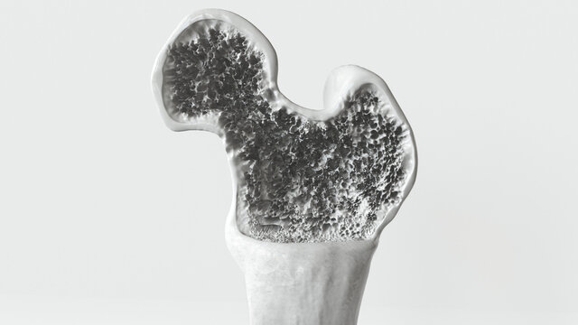 Osteoporosis stage 3 of 3 -- 3d rendering