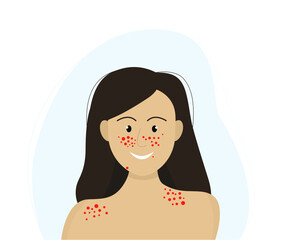 young girl with skin rashes on the face, a symptom of lupus erythematosus. Vector illustration in flat style