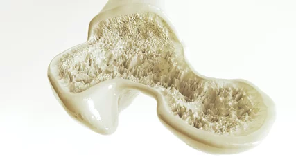 Stof per meter Osteoporosis stage 2 of 3 -- 3d rendering © crevis