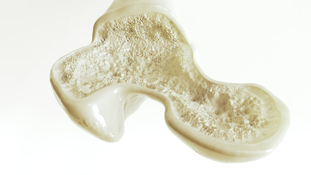 Osteoporosis stage 1 of 3 -- 3d rendering