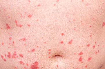 Close-up of skin disorder as hives or allergy. Human body with rash