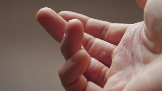 The wart dermatology hand fingers man skin closeup refocusing