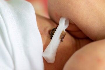 A close up portrait of a black and brown umbilical or navel cord pinched off and dying away by a clip. This way the belly button of the child is formed.